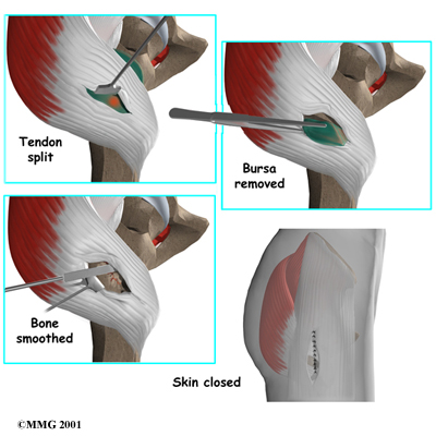 https://www.combinedtherapyspecialties.com/media/img/1162/hip_bursectomy_surgery05.jpg